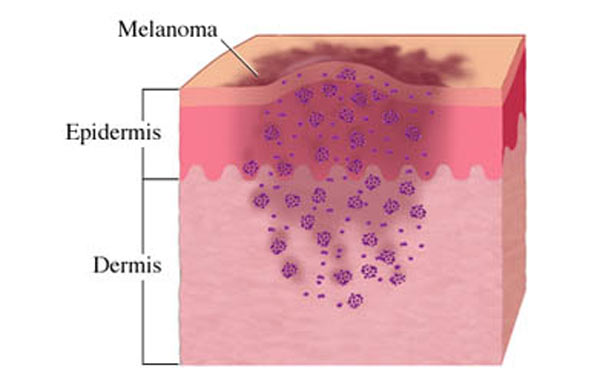 Cómo detectar el cáncer de piel 2