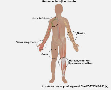 Sarcoma en tejidos blandos